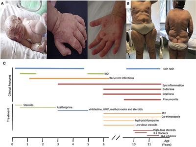 Novel PLCG2 Mutation in a Patient With APLAID and Cutis Laxa